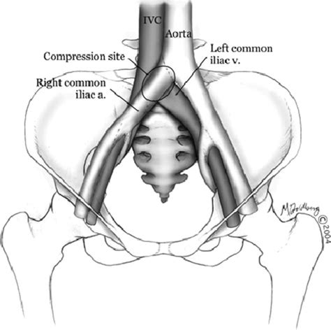 side lying iliac compression test|symptoms of iliac vein obstruction.